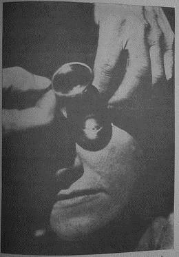 Bates 书里的图 48:用放大镜把阳光聚焦到一个病人的眼睛上。(本文注:请勿尝试!)